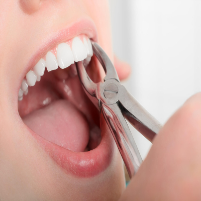 tooth-extraction